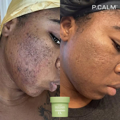 HOLY Basil- Obtenez un visage propre et sans imperfections en 7 jours !